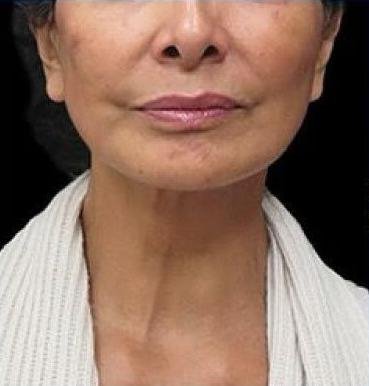 شد الوجه غير الجراحي باستخدام تقنية الاقماع الحديثة المطورة بعد