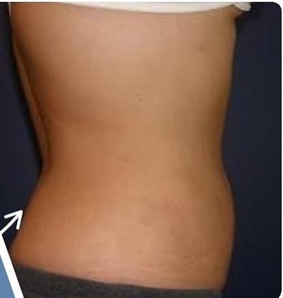 SmartLipo Triplex شفط و شد و نحت الدهون و الجلد بالليزر الامريكي بعد
