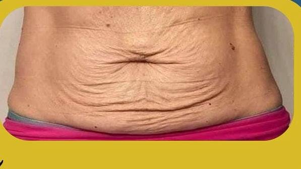 SmartLipo Triplex شفط و شد و نحت الدهون و الجلد بالليزر الامريكي قبل