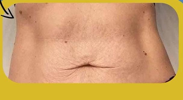 SmartLipo Triplex شفط و شد و نحت الدهون و الجلد بالليزر الامريكي بعد