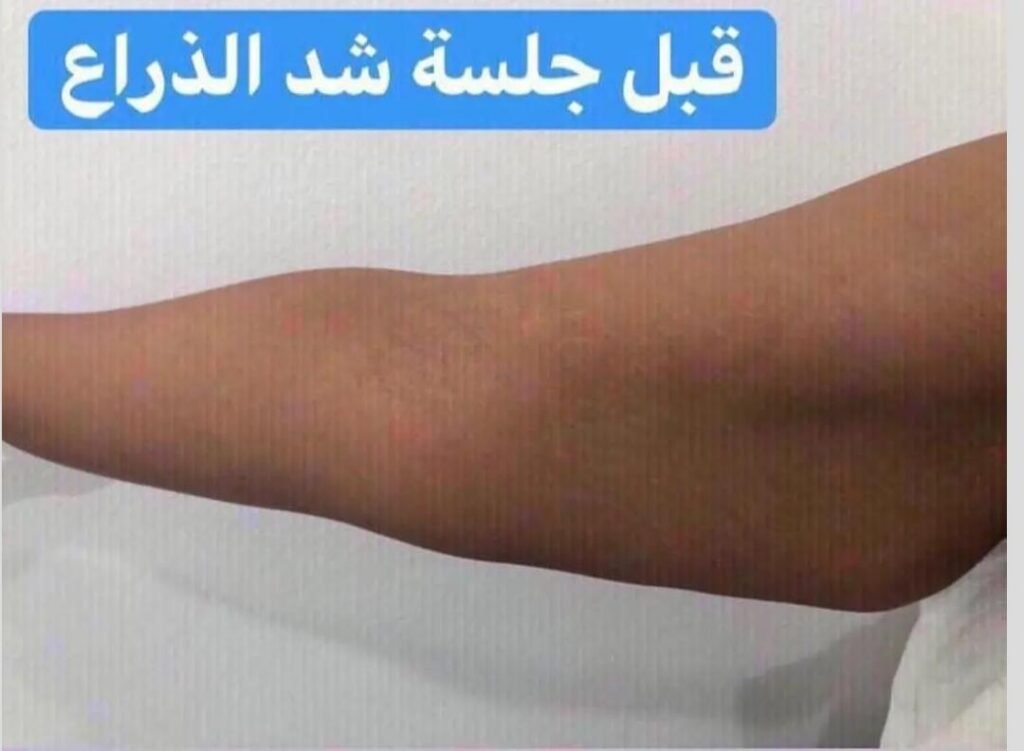 التبريد وتخسيس الدهون الموضعية بدون جراحة 1